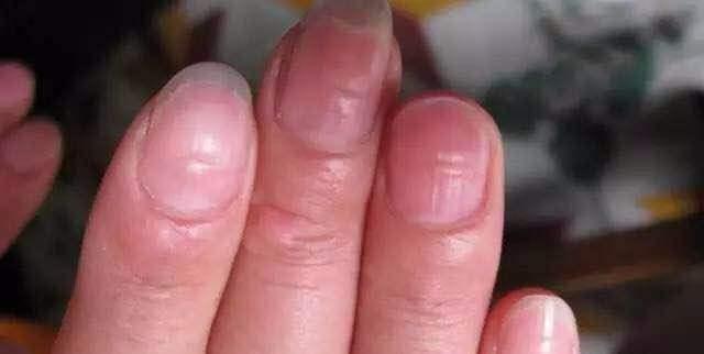 指甲上出现很多竖纹,就是大病的征兆吗?看看养生专家怎么说