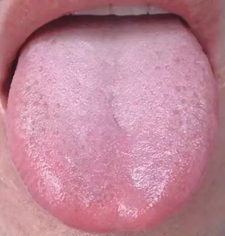 健康色舌头